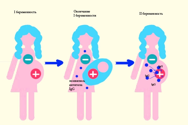 Резус-конфликт при беременности