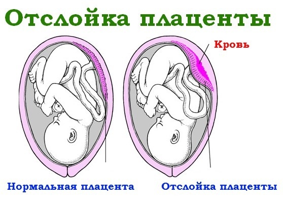 осложнение беременности Отслойка плаценты