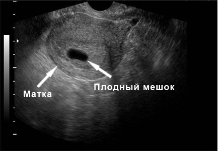 Фото УЗИ 5 неделя беременности