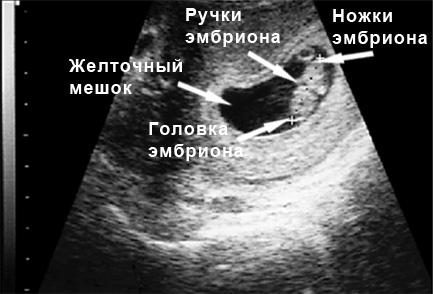Фото УЗИ 8 неделя беременности