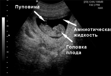 Фото УЗИ 10 неделя беременности