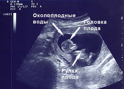 Фото УЗИ на 12 неделе беременности