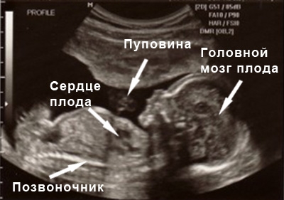 Фото УЗИ на 13 неделе беременности