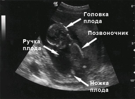 Фото УЗИ на 14 неделе беременности