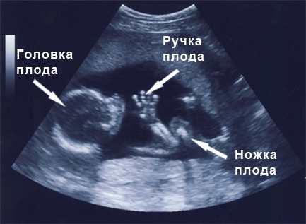 Фото УЗИ на 17 неделе беременности