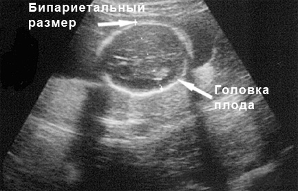 Фото УЗИ на 18 неделе беременности