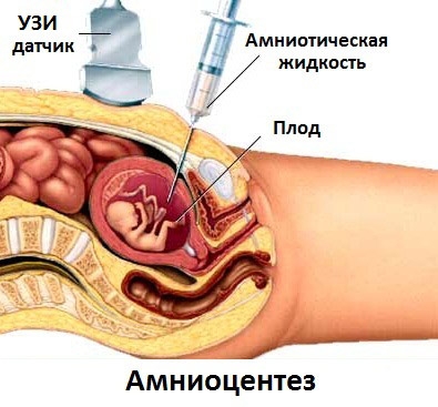 амниоцентез на 19 неделе беременности