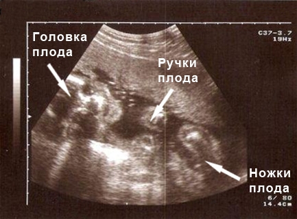 Фото УЗИ на 24 неделе беременности