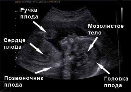 Фото УЗИ на 25 неделе беременности