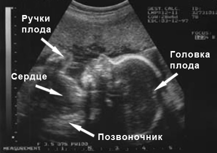 Фото УЗИ на 28 неделе беременности