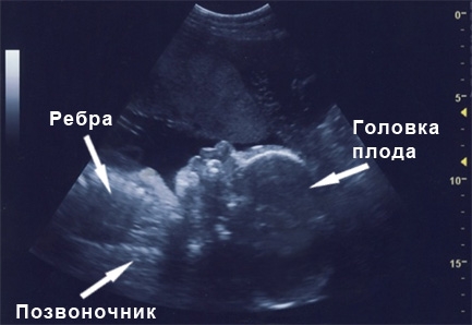 Фото УЗИ на 29 неделе беременности