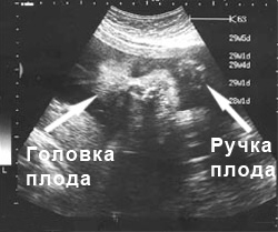 Фото УЗИ на 30 неделе беременности