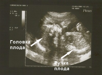 Фото УЗИ на 37 неделе беременности