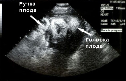 Фото УЗИ на 38 неделе беременности