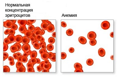 Анемический синдром
