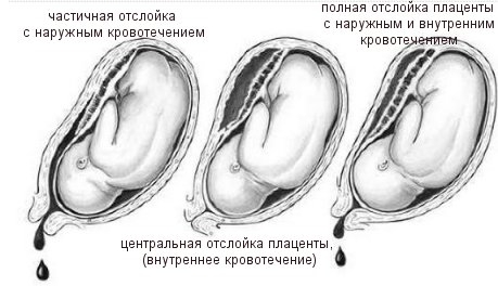 Преждевременная отслойка нормально расположенной плаценты классификация