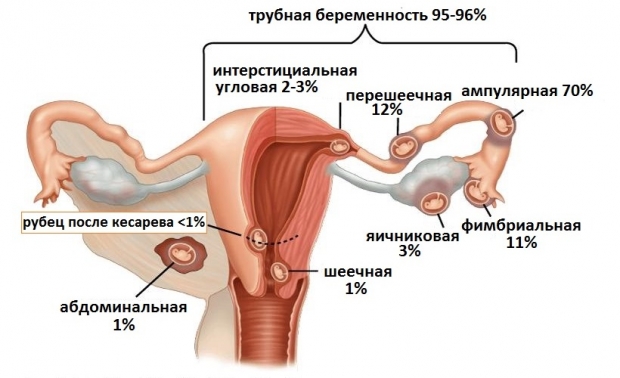 Внематочная беременность что это такое