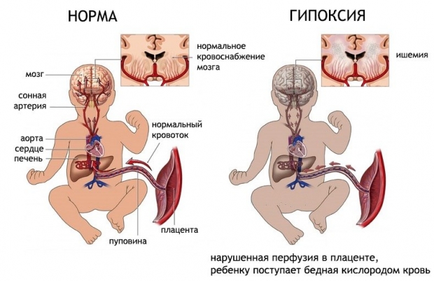 Фетоплацентарная недостаточность что это такое