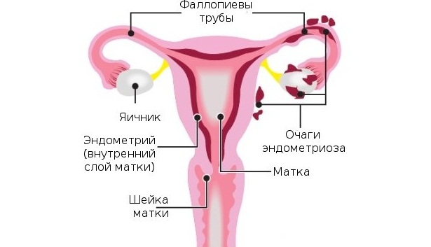 Эндометриоз