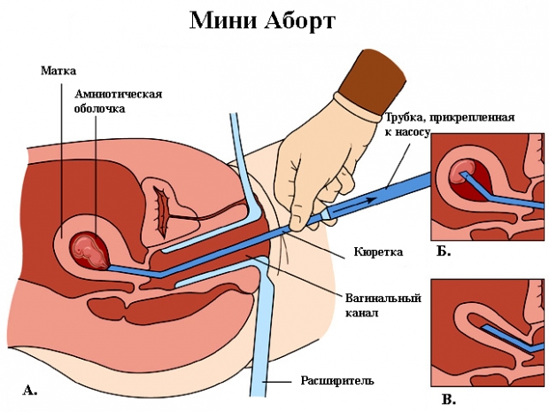 Вакуумный аборт