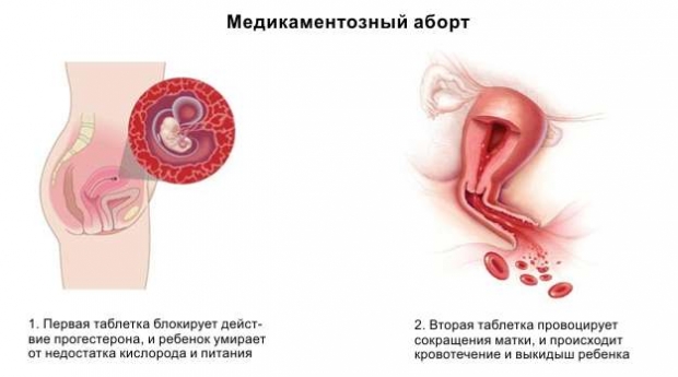 Медикаментозный аборт