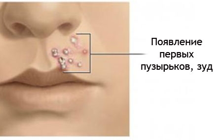 Стрептодермия при беременности