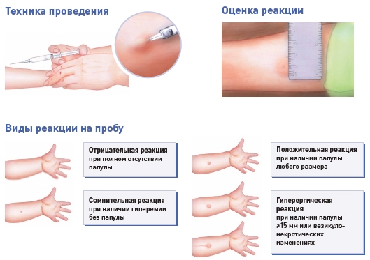 реакция манту