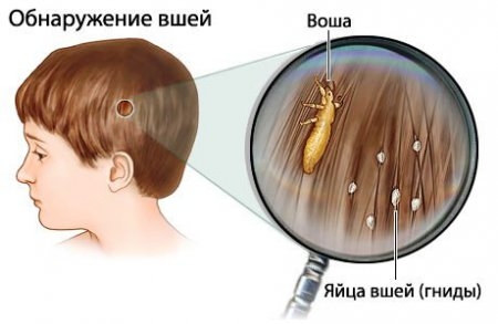 Диагностика педикулеза