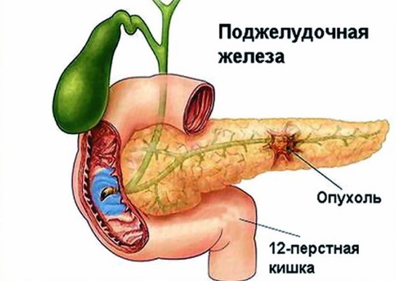 Если рак может ли болеть спина