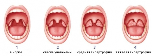 степени увеличения миндалин у детей