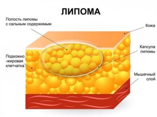 Небольшая шишка на спине болит