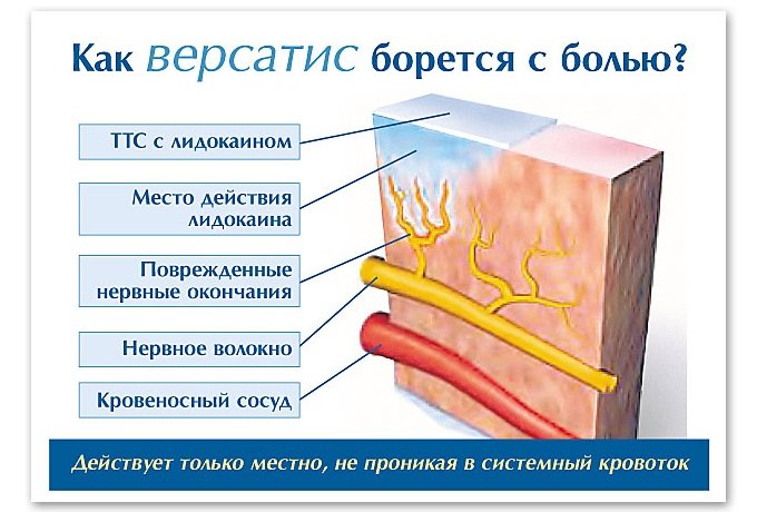 Действие пластыря Версатис