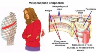 Болит под левым ребром с отдачей в спину